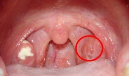 扁桃腺肿可以吃哈密瓜吗,适宜还是禁忌？