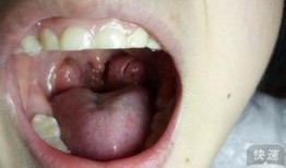 扁桃腺肿可以吃哈密瓜吗,适宜还是禁忌？