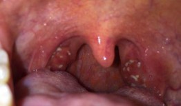 吃瓜后喉咙发涩,原因与缓解方法